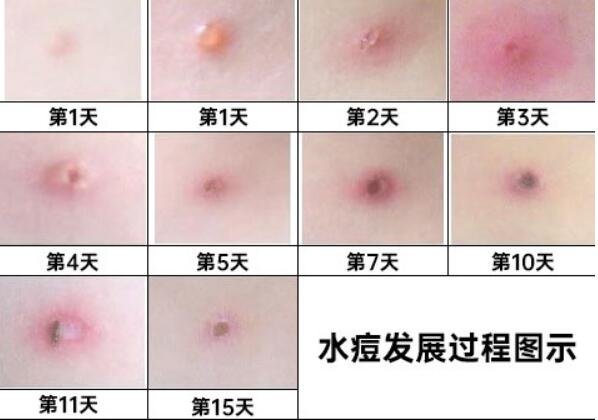 水痘的7天演变过程图片,会对人体免疫系统造成非常严重打击